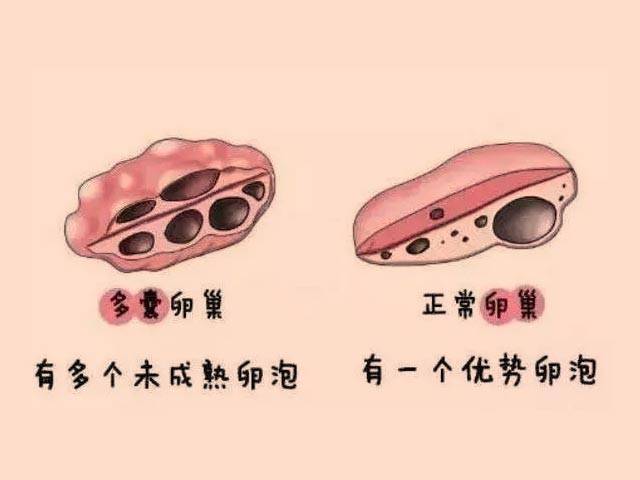 多囊卵巢怎么调理才能好？南昌贡方堂妇科老中医治疗案例分享！