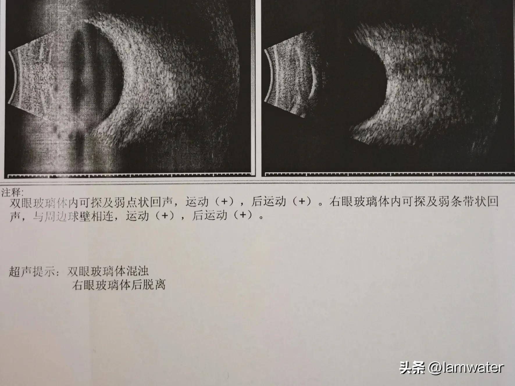 还做了眼睛的彩超,显示双眼有玻璃体混浊,右眼还有玻璃体后脱离.