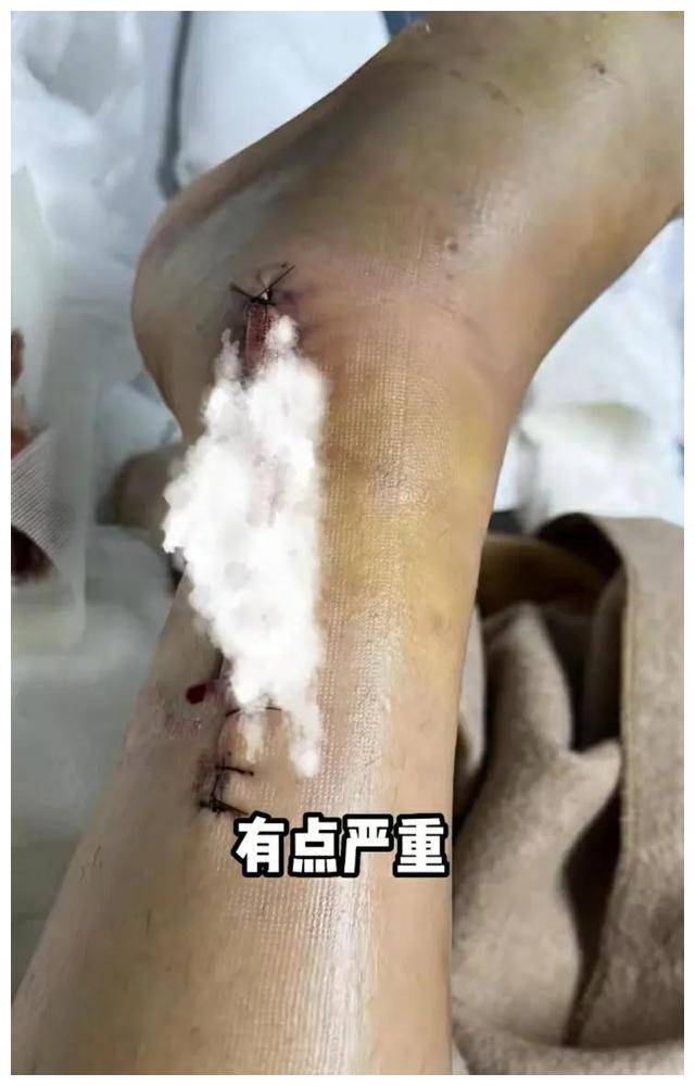 车祸腿受伤图片