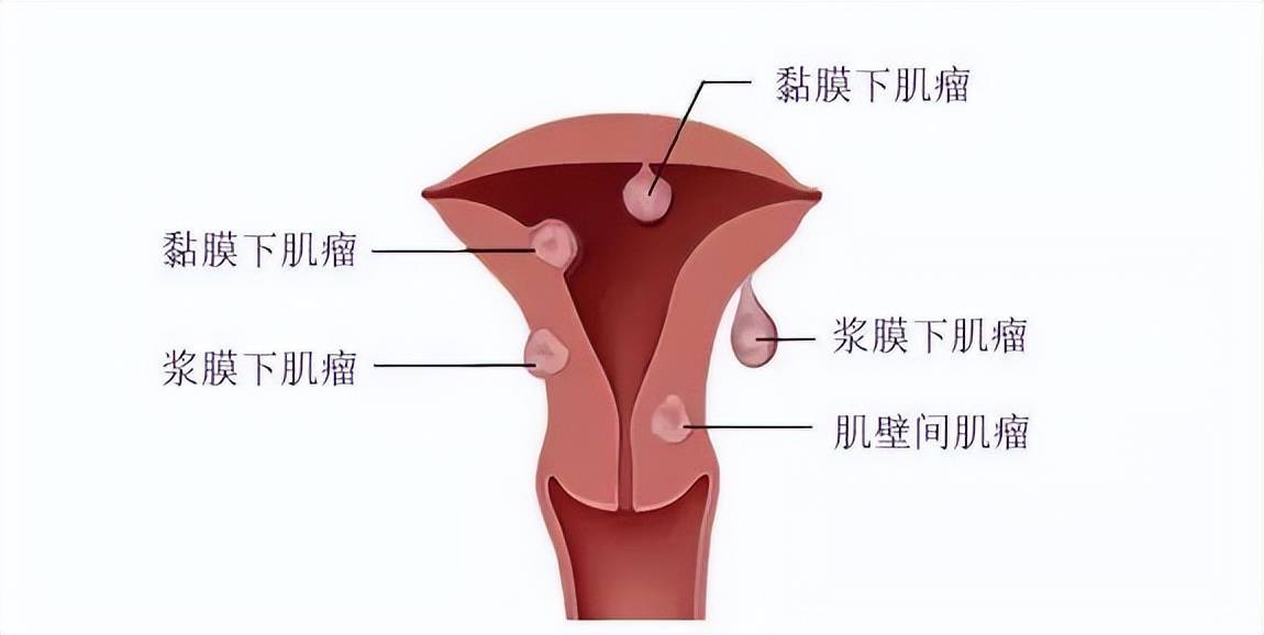 子宫前壁肌瘤的位置图图片