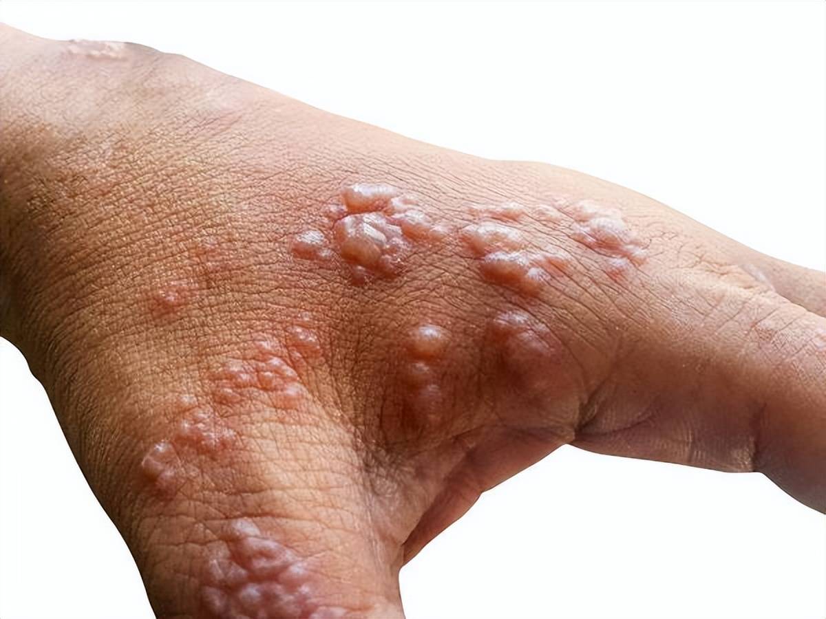 带状疱疹有多疼 是什么原因引起的和如何治疗？
