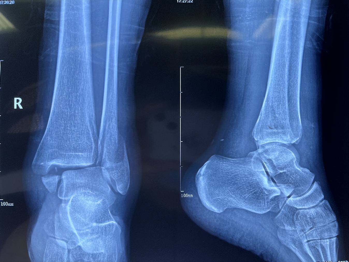 膝关节带袢钛板图片