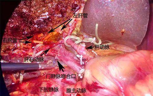 华西医生用这种创新手术方法挽救复杂胆囊癌患者_胆管_腹腔镜_恶性