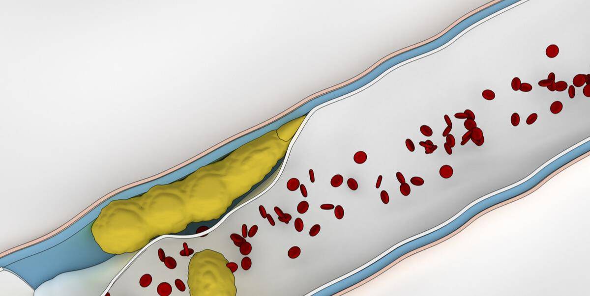 血管垃圾该如何正确处理?医生告诉您_斑块_脂肪_生活