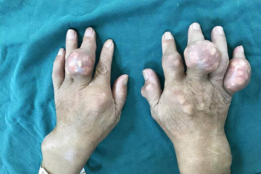 出现关节痛,分不清是痛风还是骨关节炎?