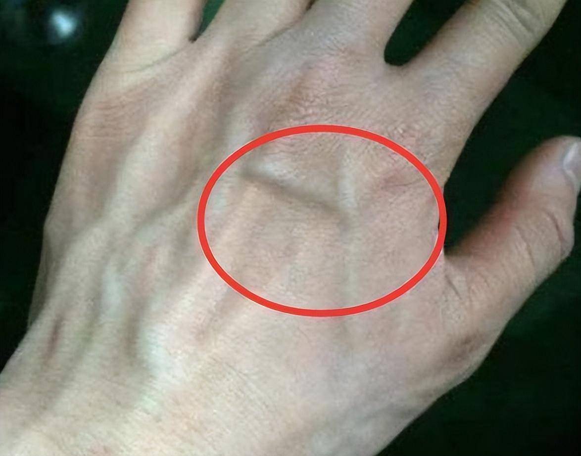 静脉曲张是青筋突起吗?腿上突然出现青筋凸起,虽然会观察到