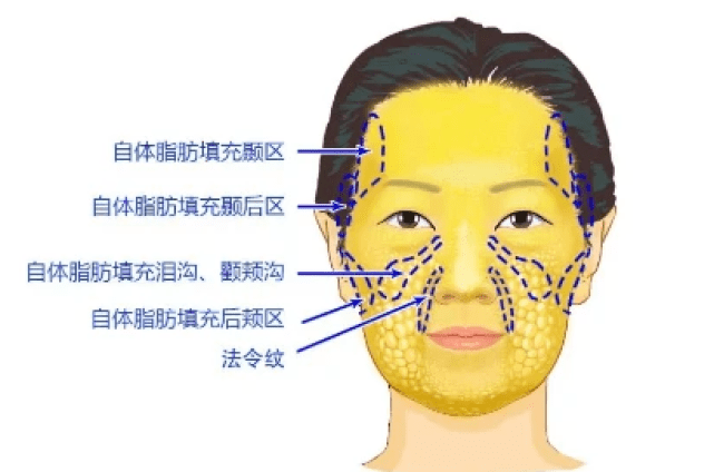脂肪面部填充保持多久_填充面部脂肪保持几年_填充面部脂肪保持多久