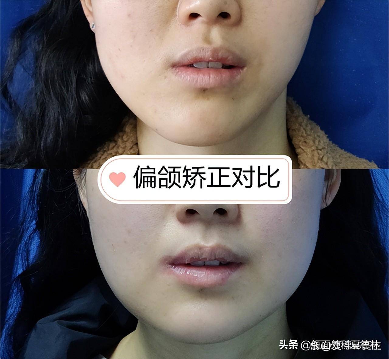 天生面部不对称,正颌手术帮你拯救"歪下巴"_问题_严重_骨骼