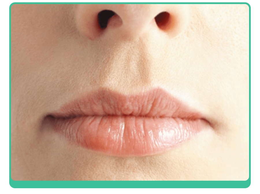 急性唇炎是什么原因引起的 如何预防？