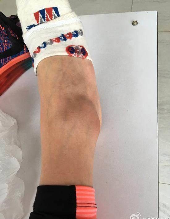 傅园慧真倒霉!半夜胃疼 脚崴了,发微博说:最近诸事不顺!