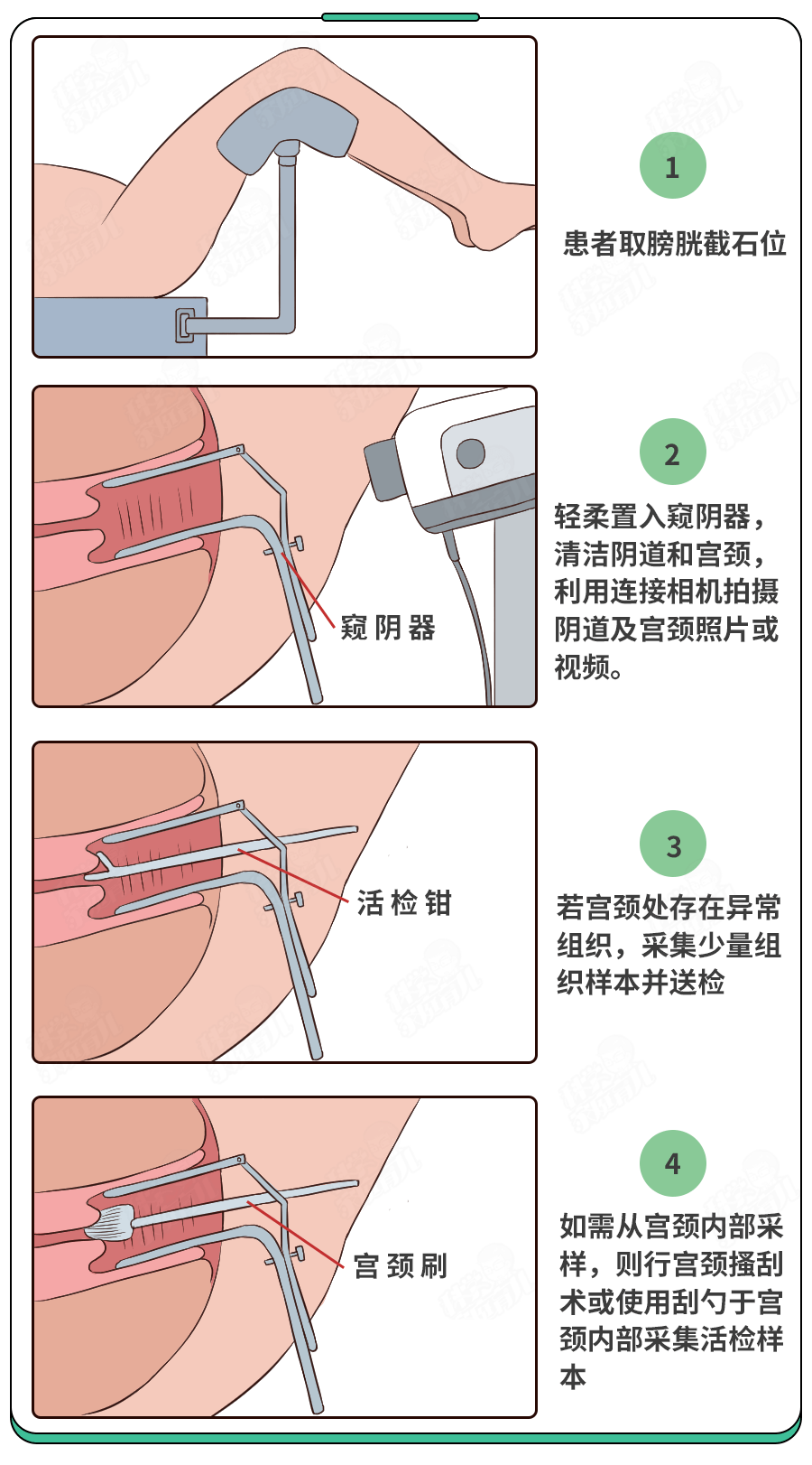 宫颈癌筛查项目和流程有哪些 打了HPV疫苗就可以完全放心了吗？