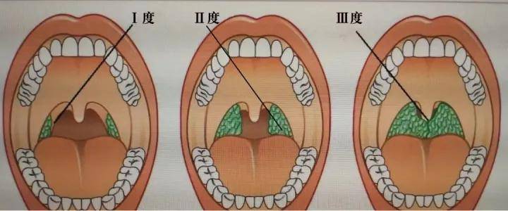 治疗【扁桃体肥大】中医也可以,不打针,不吃药更不用手术_家长_影响
