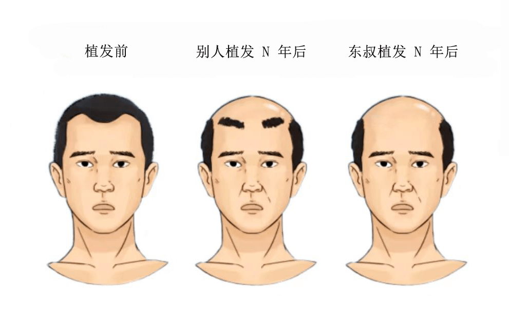 宁德毛囊植发(宁德哪里有植发)