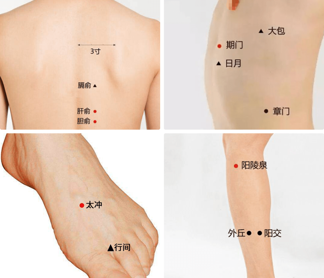 艾灸保健,以肝經,膽經的腧穴為主穴,重點艾灸期門穴,章門穴,太沖穴