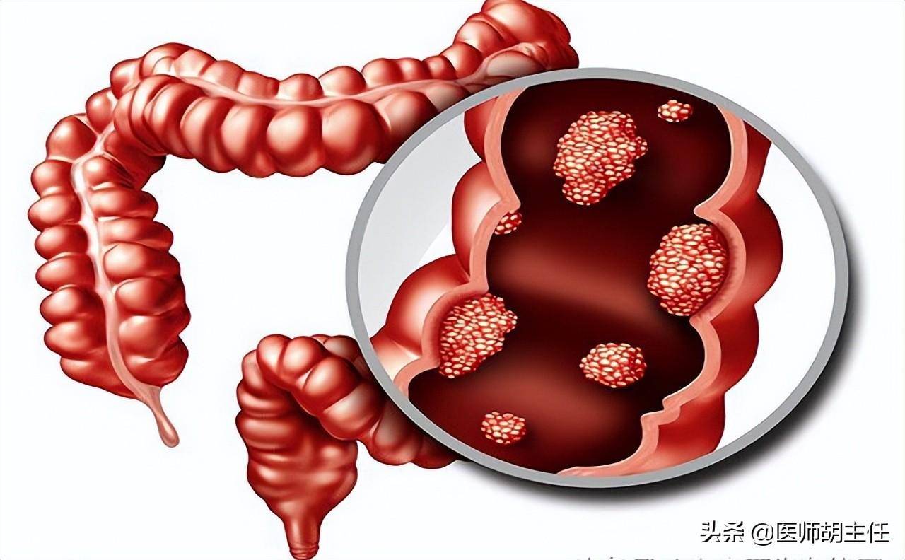 肠癌来临前,会先经历3个症状!