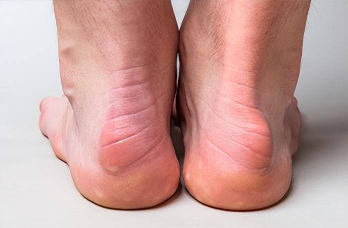 跟腱炎康复动作在这里!_肌腱_脚跟_脚趾