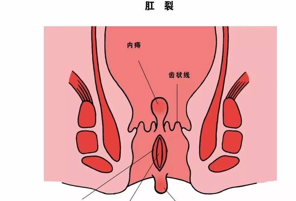 别傻了,当心直肠癌_诊断_检查_肛门