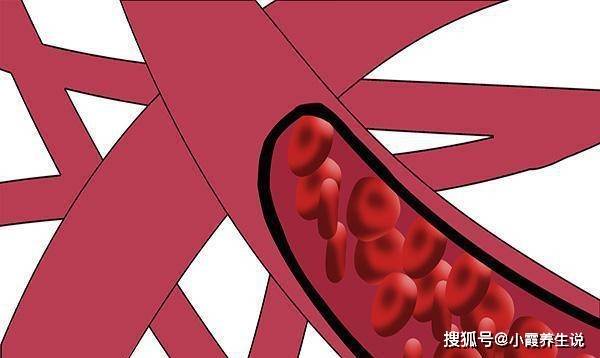 原创            甘油三酯高到5.6，算很严重了吗？要怎么才能降回到正常指标？