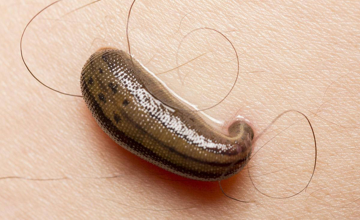 当水蛭尝试进入人体内时,皮肤组织会产生局部的炎症反应,以阻止寄生虫