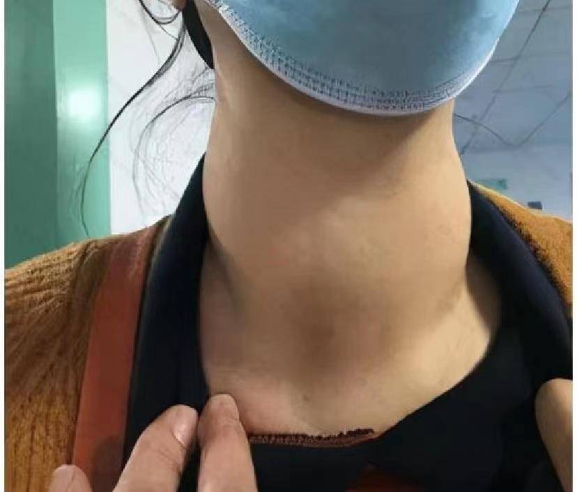 得了甲状腺结节怎么办!专家揭晓最佳治愈疗法,45天告别大脖子!