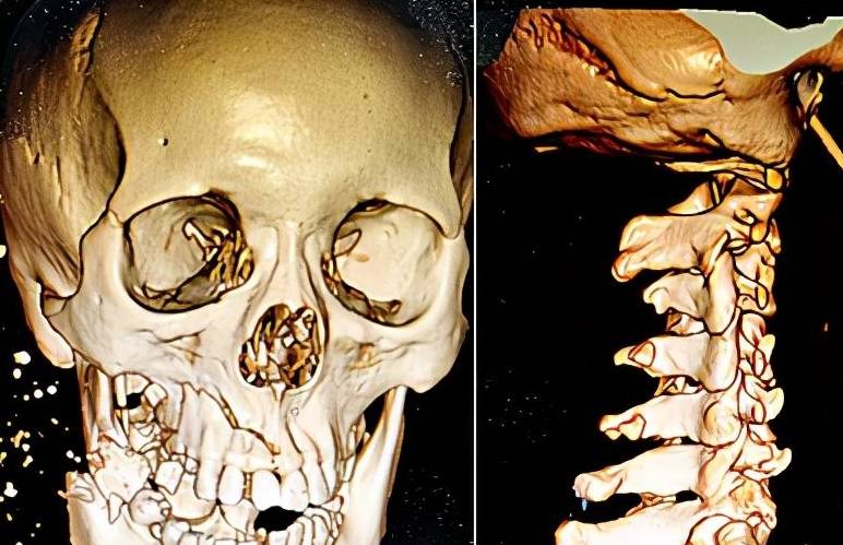我院顱面部ct提示:下頜骨,右側上頜骨多發骨折,斷端錯位,周圍軟組織