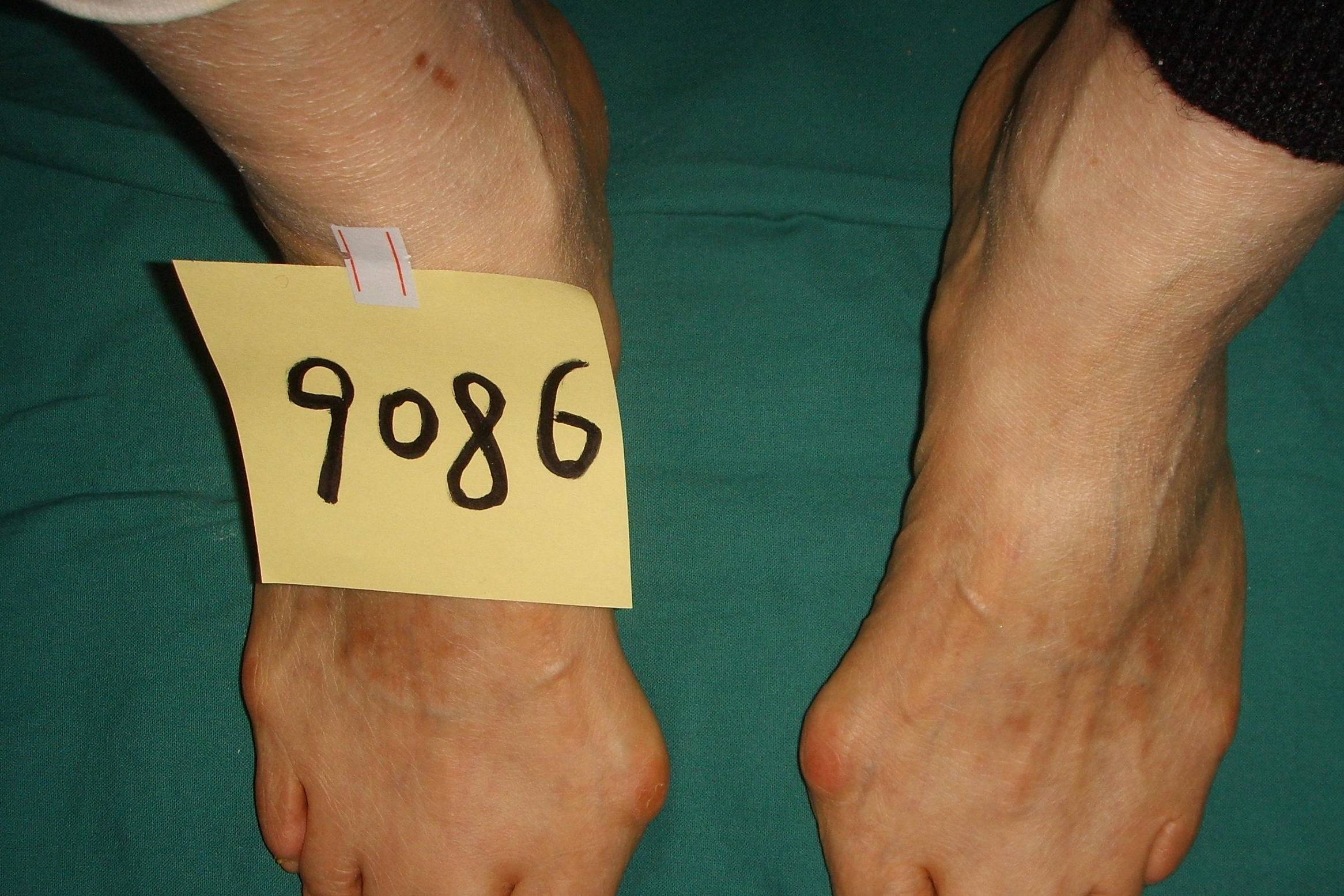 广东河源58岁大姐大脚骨,前足足横弓塌陷,脚很宽怎么办_手术_工作