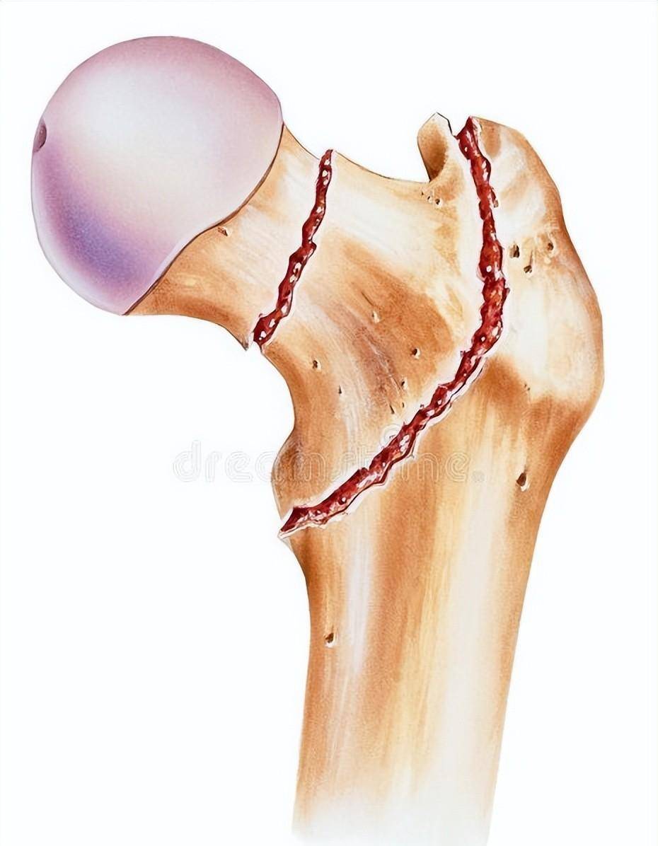 老年髋部骨折包括股骨颈骨折以及股骨粗隆间骨折,此类骨折因死亡率极