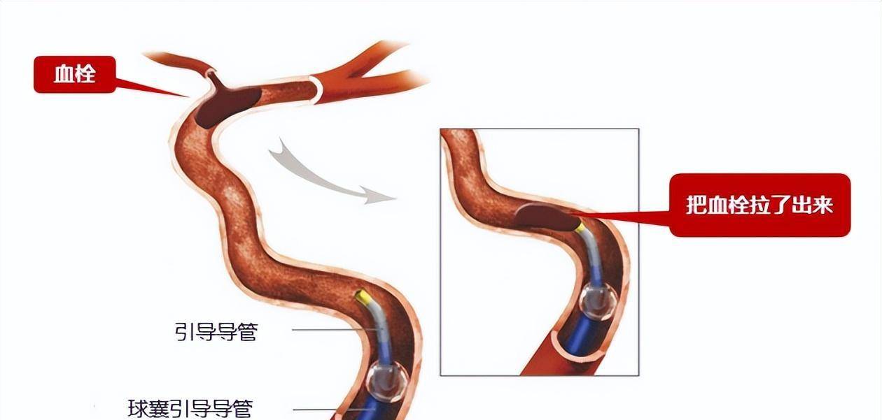 卒中入院，错过了溶栓取栓时间窗是什么意思？我还能恢复吗？(错过溶栓时间溶栓可以再溶栓吗)