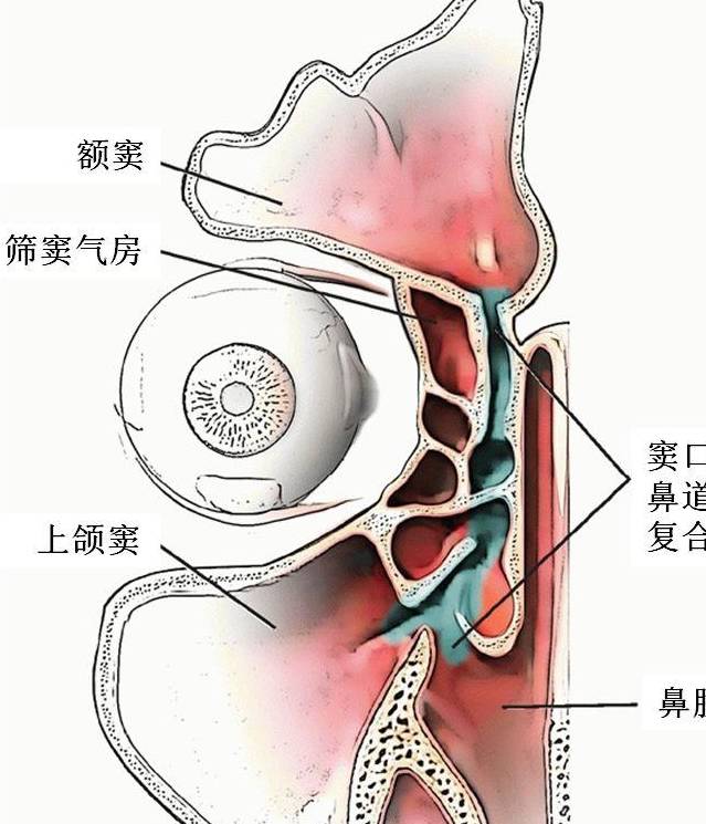 上頜竇炎遷延不愈,穿刺灌洗或可避免手術治療_病人_麻醉_鼻腔