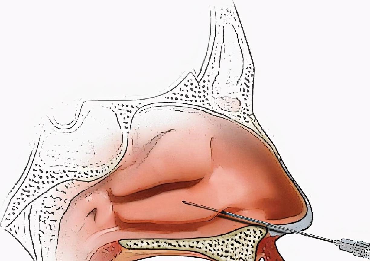 上頜竇炎遷延不愈,穿刺灌洗或可避免手術治療_病人_麻醉_鼻腔