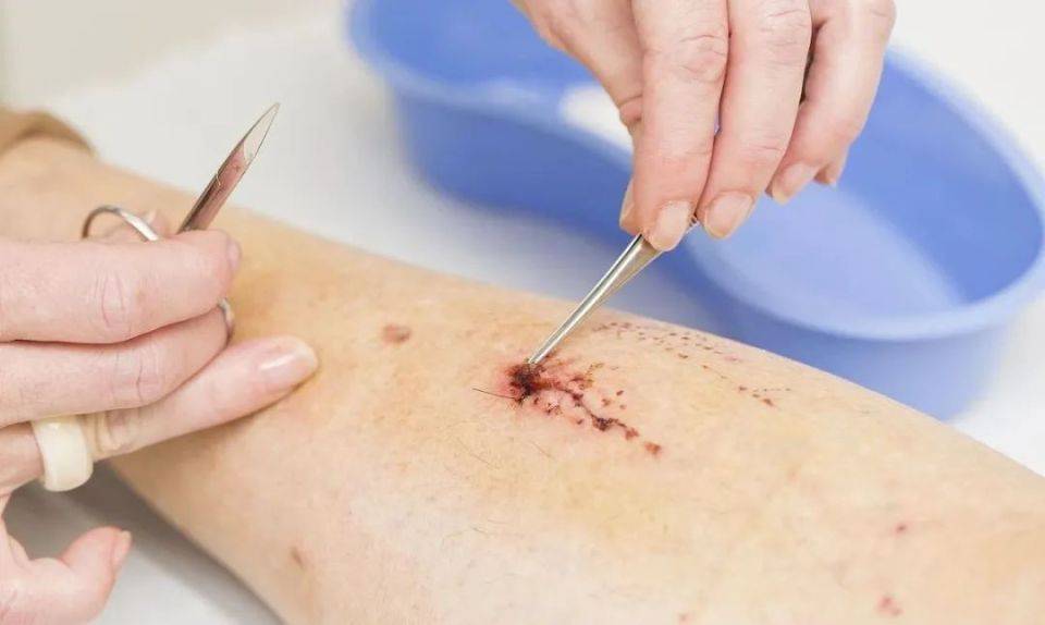 伤口渗液的管理,青岛中腾生物带你了解_敷料_组织_因素