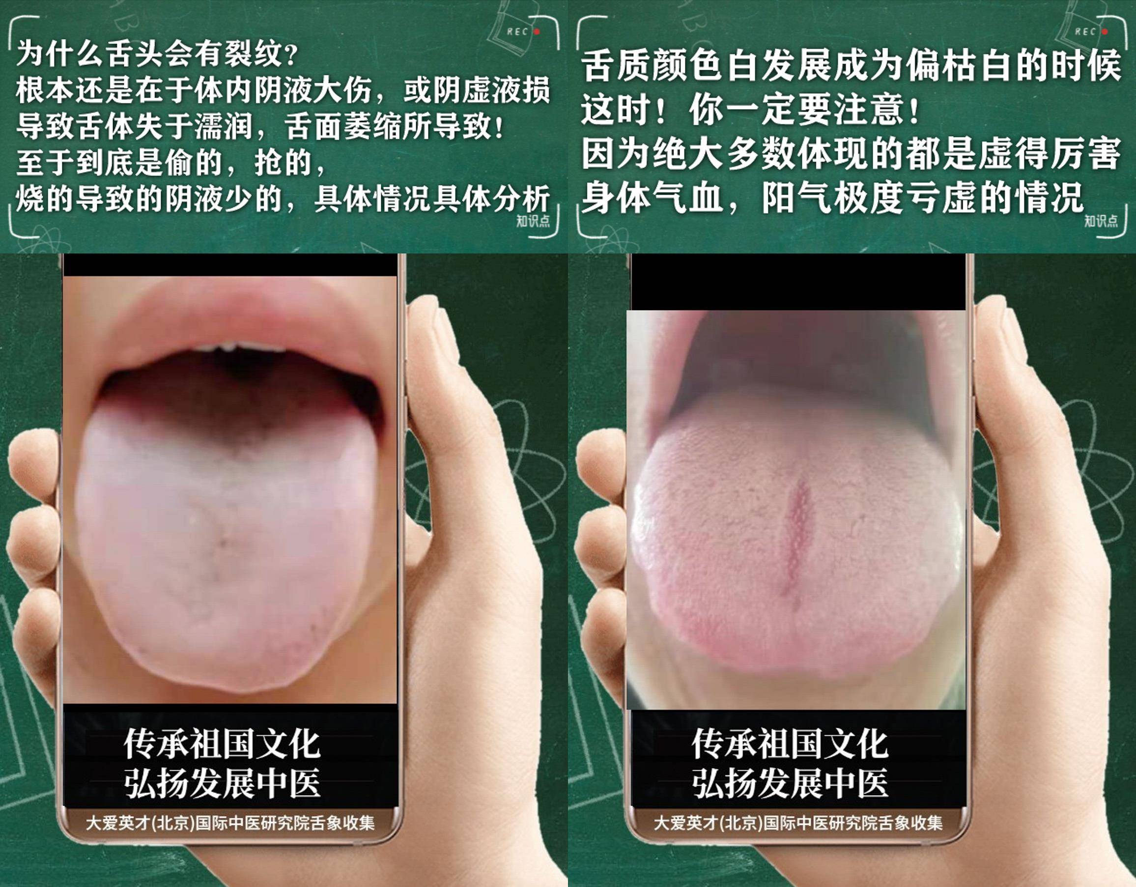 中医解剖:容易心慌出虚汗,头身重困,气阴两虚_mmhg_分析_参考
