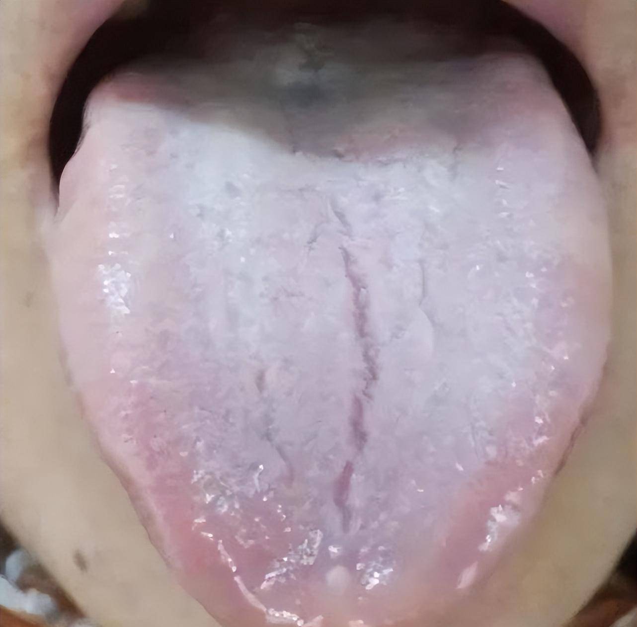 舌头有裂纹是怎么了?教你辨别四种常见裂纹舌,看看你是哪一种?