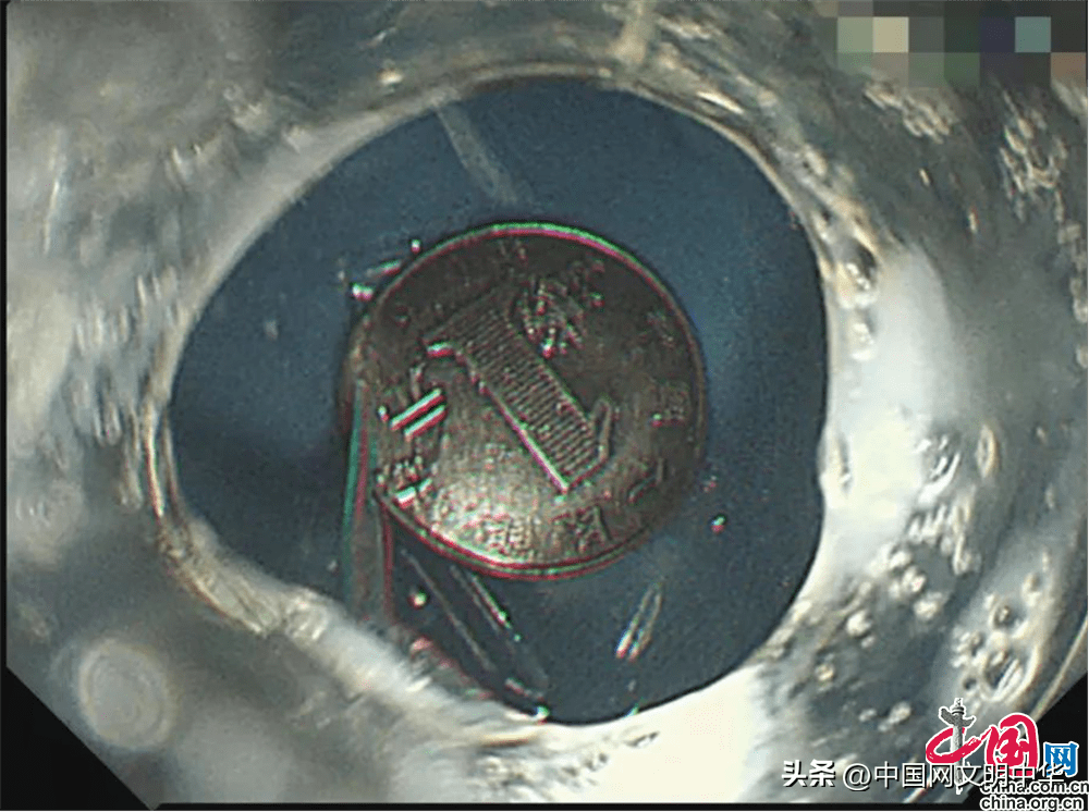 原创            安徽阜阳市肿瘤医院：耗时3分钟 顺利取出7岁儿童误吞的1元硬币（安徽阜阳肿瘤医院怎么样知乎）