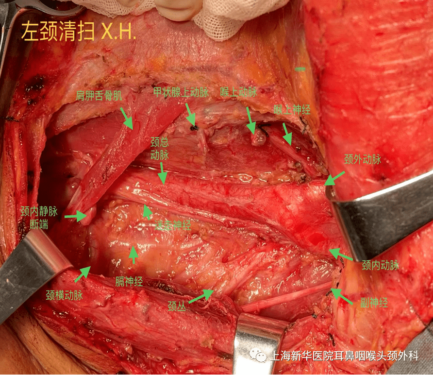 淋巴结手术图片图片