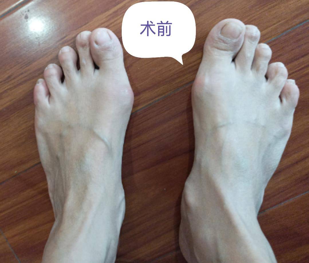 江苏42岁拇外翻患者术后有疑问:拇趾为什么会上翘,会有影响么?