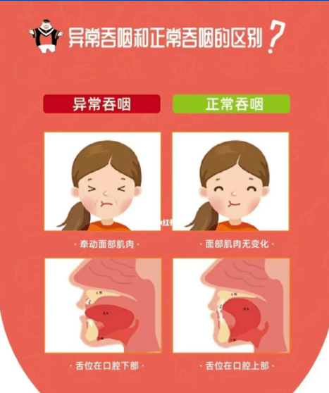 言语不清,喝水呛咳等症状——吞咽功能障碍康复技术助你恢复_训练