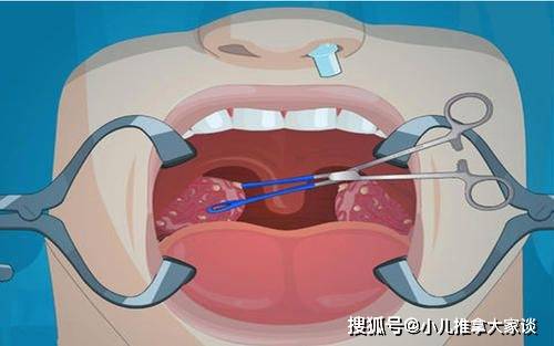 小儿推拿杨晓:宝宝扁桃体肿大发炎是由内热造成吗?