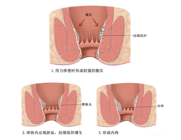 痔疮在什么位置图片图片