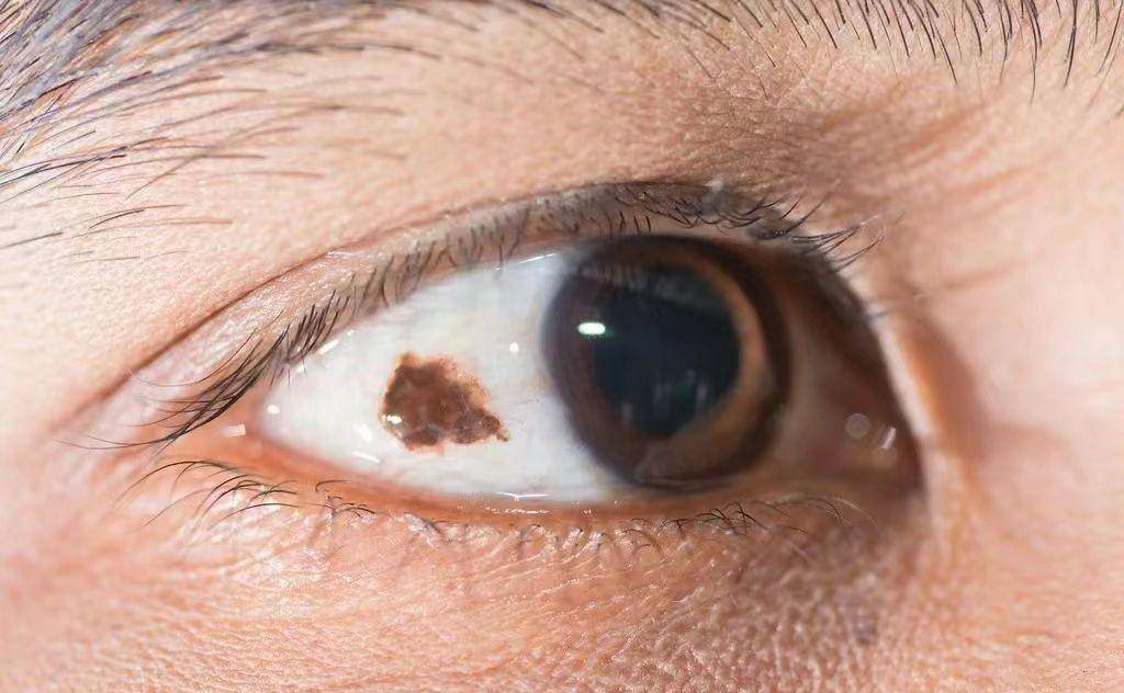 白眼球上的黑斑是脏东西吗
