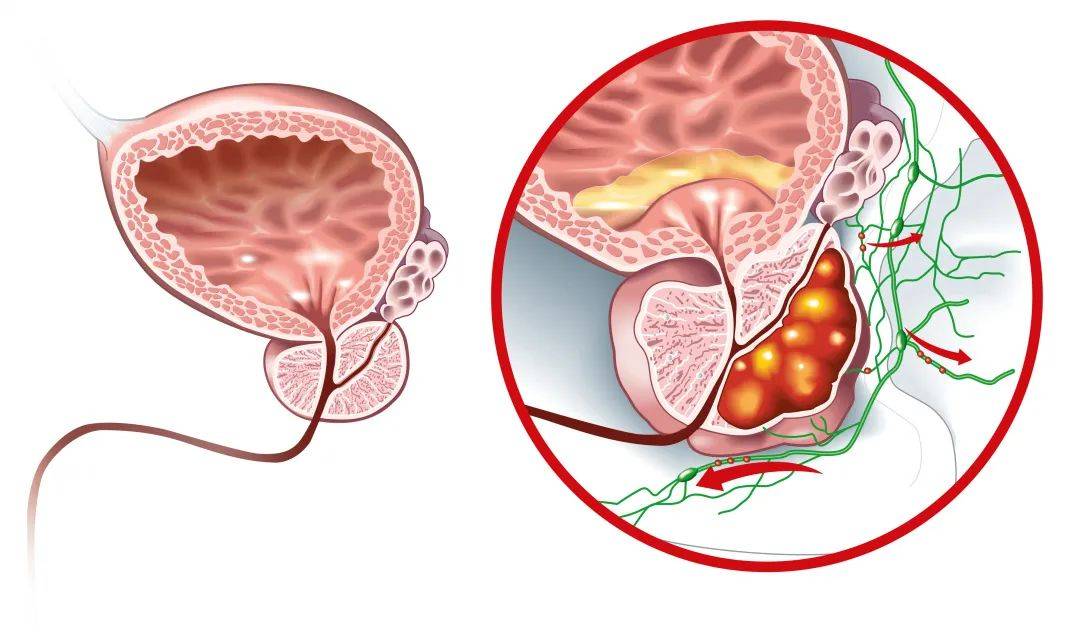 前列腺癌的早期症状图片