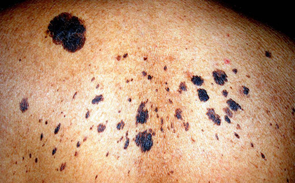 医生再三提醒:长在4个部位的痣,或与病症"相关"