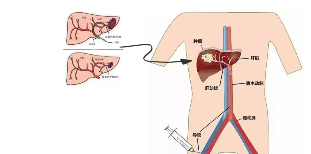 肝动脉化疗栓塞术