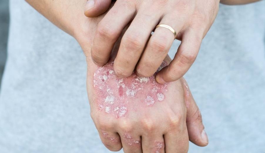 女子腋窝有肿块,怀疑艾滋病,医生一看,竟是患上"猫抓病"_周女士_淋巴