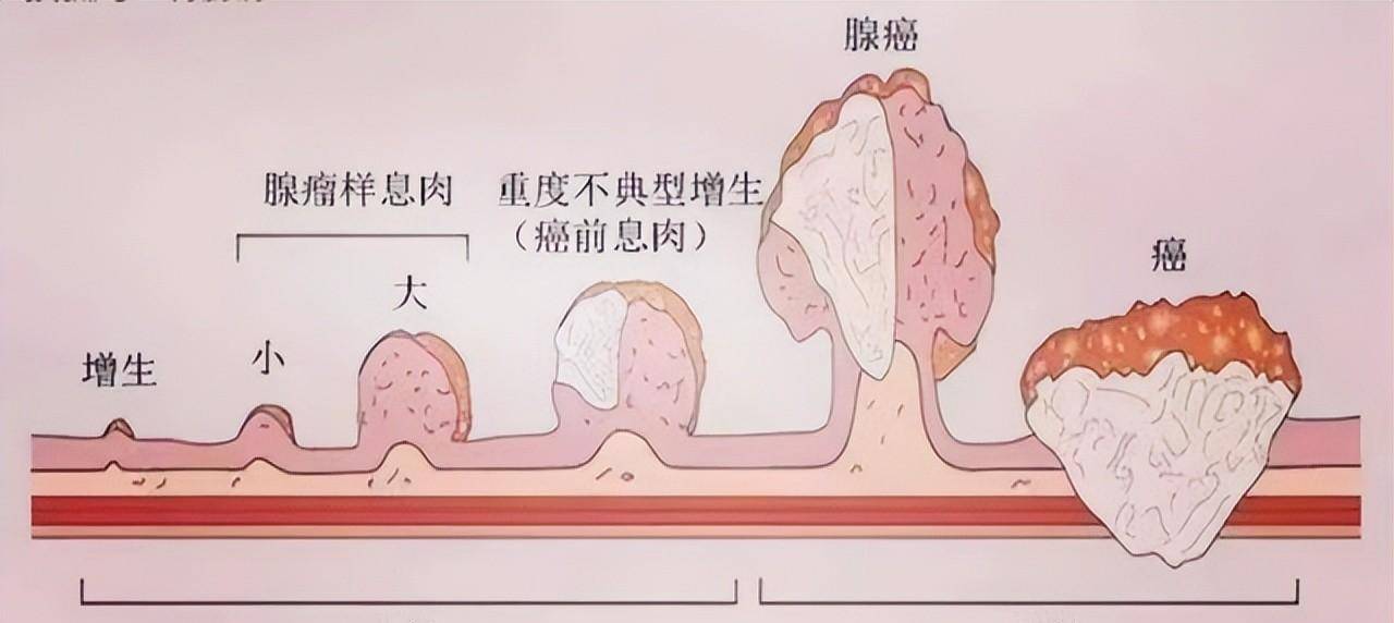 大腸的組織學分層從腸腔向外分別為黏膜層,黏膜下層,肌層和漿膜層.