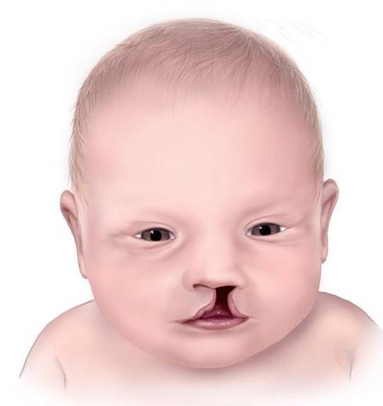 其中,大约1/1700的人只有腭裂,大约1/2800人中有一人患有唇裂.