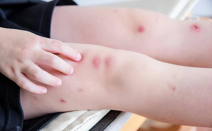 男子被蚊子咬了一口,住进icu差点丢了命,医生:夏季不得不警惕_邓先生