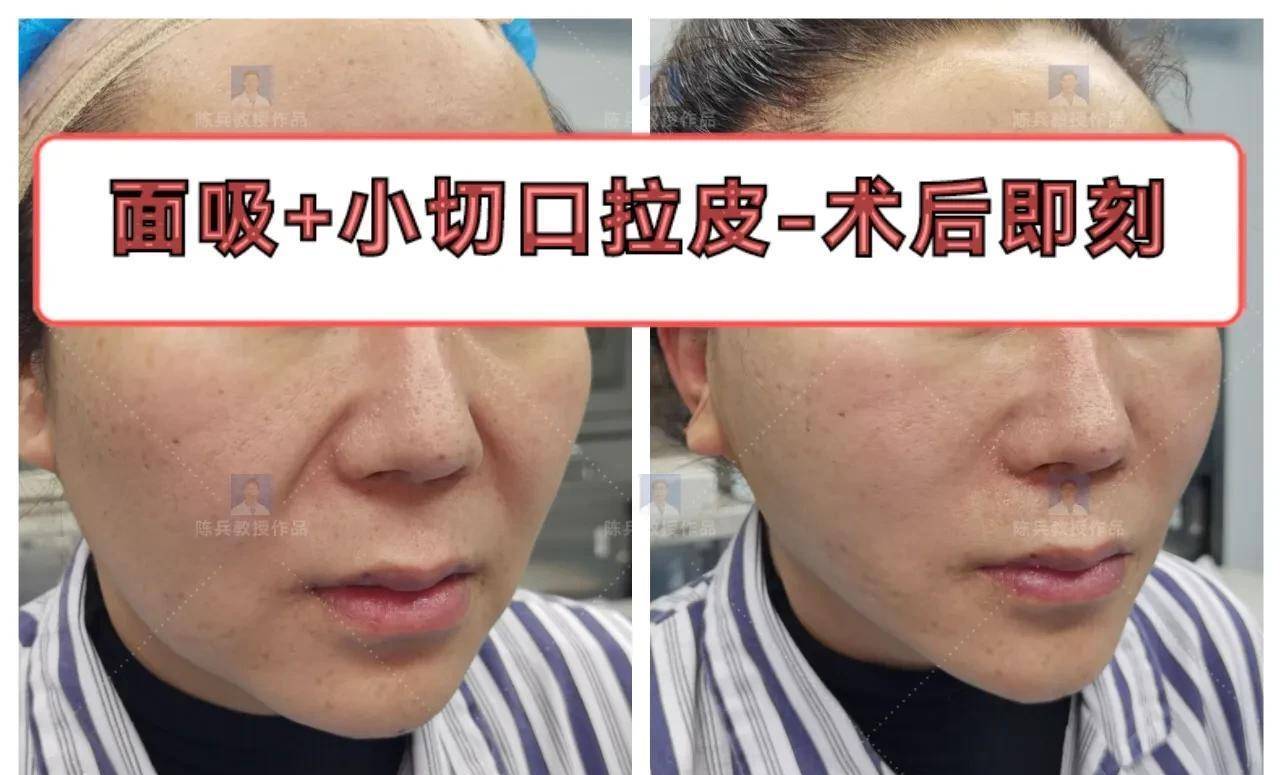 头脑发热,飞去广州做了小拉皮,奉劝想要做的人先听我说_陈教授_手术