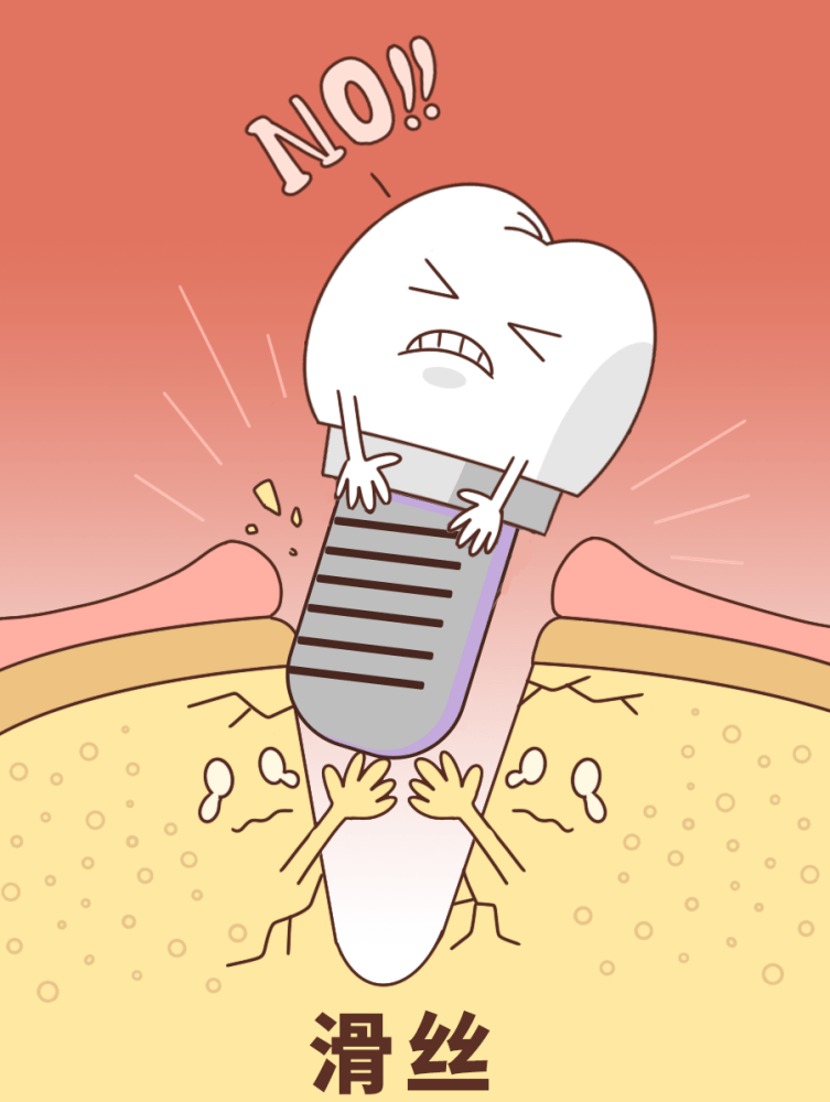 种植牙不要种 会脱落
