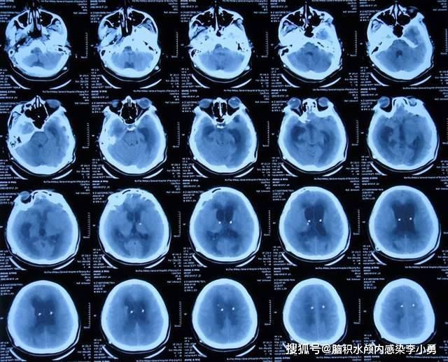 双侧脑室腹腔分流术后22天即2016年7月29日,查头颅ct示脑室扩张明显